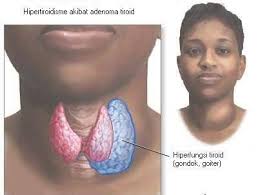 penyakit hipertiroid